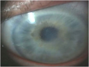 corneal edema