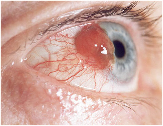eye cancers