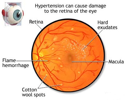 hypertensive retinopathy